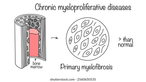 Drawn overgrowth of connective tissue in the bone marrow, which disrupts normal hematopoiesis. Medical diagram of the disease. Vector illustration. Primary myelofibrosis.