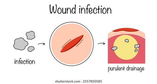 Drawn process of infection entering an open wound and the formation of a purulent wound. Development of microbial inflammatory process in damaged tissue structures. Wound infection.