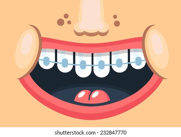 Drawn sweet smile of a child with braces. Vector illustration in a flat style.