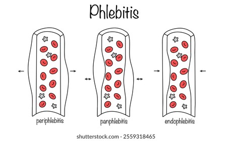 Drawn three types of phlebitis. Inflammation of the outer wall of blood vessels, the inner wall of blood vessels and both walls. A simple illustration for use in the medical field.