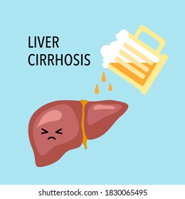 Drinking beer or alcohol beverage can damage liver. Liver cirrhosis disease vector illustration. Healthcare concept.