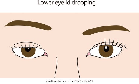 droopy eyelid, droopy eyelid, eye, eyelid, drooping, ophthalmology, case, vector illustration