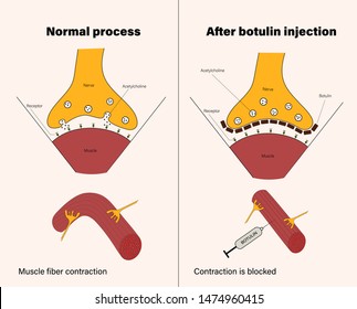 Drug made from the botulin botulinum toxin produced by bacterias used in cosmetology for remove wrinkles infographics information poster for students and patients