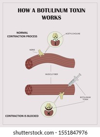 Drug Medication Medicine Made Botulin Botulinic Botulinum Toxin Produced Bacteria Used Cosmetology Remove Wrinkles Infographics Information Poster Students And Patients Beautician Cosmetologist Doctor
