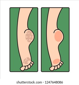 Dry Cracked Female Feet, Care For Dry Calloused Feet, Heels Before And After Pedicure. Vector Flat Illustration