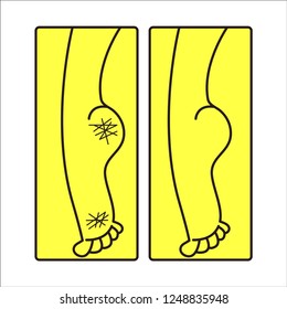 Dry cracked female feet, care for dry calloused feet, heels before and after pedicure. Vector line illustration