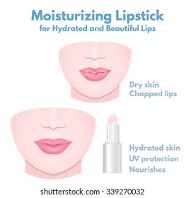 Dry Cracked Lips Close-up And Hydrating Balm