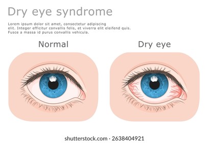 Dry eye medical illustration. Normal eye and dry eye.Vector illustration. 
