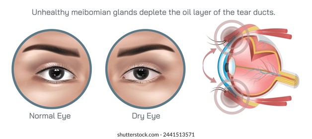 El síndrome del ojo seco, también conocido como enfermedad del ojo seco, es una condición común que ocurre cuando los ojos no producen suficientes lágrimas o cuando las lágrimas se evaporan demasiado rápido.