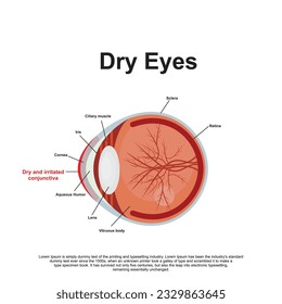 Dry Eyes Anatomy Vector Illustration