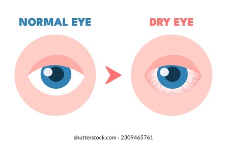 Dry eyes. Healthy unhealthy red eye, driing astonished redness irritated surface eyeball, conjunctivitis glaucoma disease or lens allergies, optometry concept vector illustration