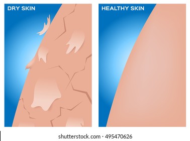 Dry and healthy skin texture , vector