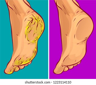 Dry Heels Before-after, Vector Illustration