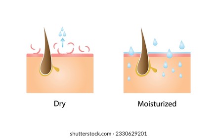 Dry and moisturized  skin. Skin cross section. Moisturized pore and dry pore. Vector illustration.