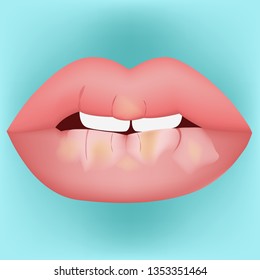 Dry Mouth Vector Illustration