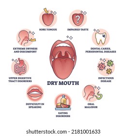 Dry Mouth Or Xerostomia As Salivary Glands Saliva Problem Outline Diagram. Labeled Educational Scheme With Medical Mouth Condition, Symptoms And Causes Vector Illustration. Dental Health Disease.