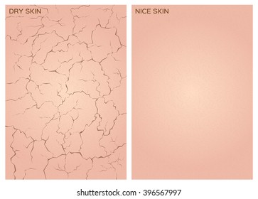 Dry And Nice Skin Texture , Vector