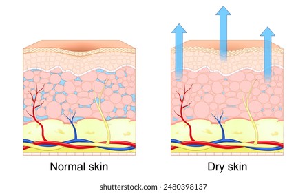 Dry and normal skin. Cross section of human skin. Loss of moisture in human skin. Vector illustration