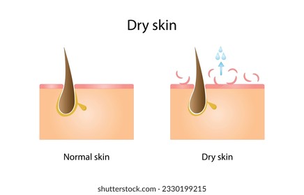 Dry skin. Comparison between normal and dry skin. Vector illustration.