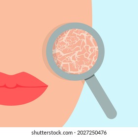 Dry skin of the girl's face through a magnifying glass. Concept: skin problems, care and cosmetics. Vector illustration, flat cartoon color minimal design, eps 10.