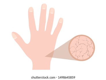 dry skin of human hand vector