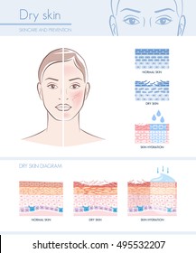 Dry Skin Hydration Infographic With Skin Diagram; Skincare And Beauty Concept