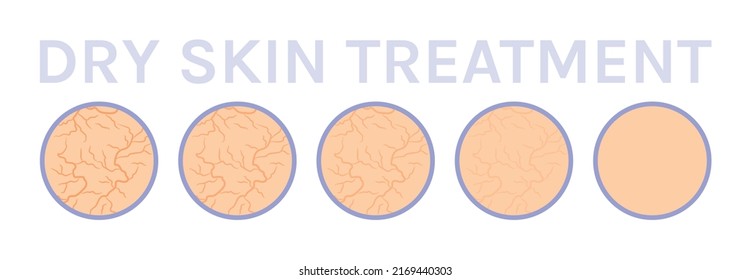 Dry Skin Icon. Cracks On Skin. Close Up. Treatment And Steps. Before After. Healthy And Soft Skin. Effect Of Cream And Moisturizer Mask. White Background. Vector Illustration For Beauty Design.