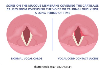 Dry Sore Loss Cough Virus Viral Acute Swell Sound Folds Treat Cysts Palsy Nerve Tumor Botox Throat Hoarse Larynx Airway Polyps Cancer Injury Speech
Damage Ulcers Motion Chronic Nodules Surgery