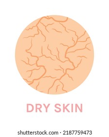 Dry Unhealthy Skin. Close-up. Facial and Body Skin Problems. Color Cartoon style. Circle. Zoom. White background. Vector illustration for Beauty Design.