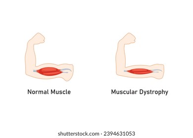 Duchenne Muscular Dystrophy (DMD) Scientific Design. Vector Illustration.