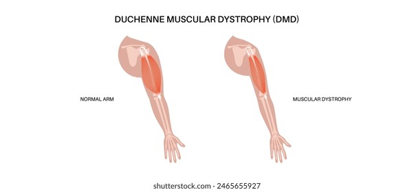 Duchenne muscular dystrophy inheritance medical poster. Hereditary neuromuscular disease. Progressive muscle fiber degeneration and weakness. Genetic mutation in human body flat vector illustration