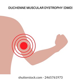 Duchenne muscular dystrophy inheritance medical poster. Hereditary neuromuscular disease. Progressive muscle fiber degeneration and weakness. Genetic mutation in human body flat vector illustration