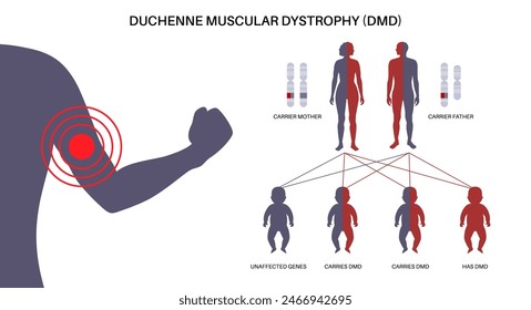 Duchenne muscular dystrophy inheritance pattern. Hereditary neuromuscular disease. Progressive muscle fiber degeneration and weakness. Affected, carriers or healthy chromosomes vector illustration.