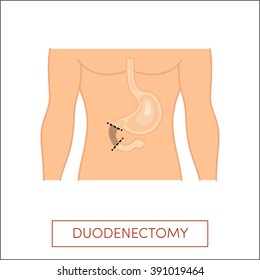 Duodenectomy - partial excision of the duodenum. Vector illustration for medical books.