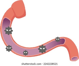 Duodenitis is a condition in which the mucous membrane of the duodenum is sore and damaged.