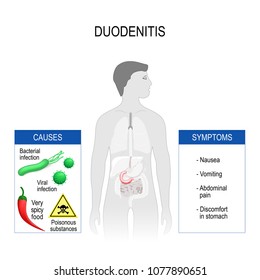 Duodenitis is inflammation of duodenum. humans silhouette with red highlight duodenum. Bacteria, viruses, spicy food (chili pepper), poisonous substance (international pictogramme) that cause disease