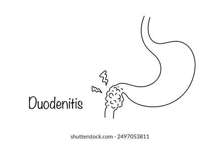 Duodenitis. An inflammatory process that develops in the mucous membrane of the duodenum. Simple black and white vector illustration.
