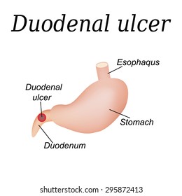 duodenal cap image clipart