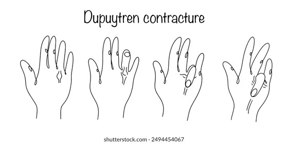 Dupuytren contracture. Deformation of the palmar tendons, which leads to the loss of the ability of the fingers to fully extend. Hand drawn progressive contracture. Vector illustration.