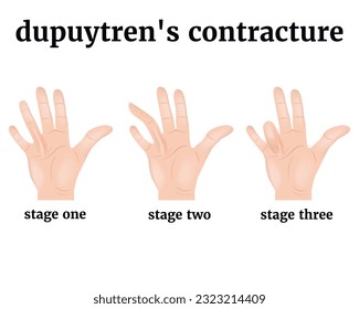 Dupuytren's contracture. 3 stages of development of the disease. Injury to the tendons of the hand, palm. Medical poster with description, vector illustration