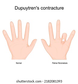 Dupuytren's contracture. Comparison and difference of a healthy hand and Dupuytren's disease in left hand. finger that bend in towards palm. Vector illustration