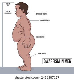 Dwarfism and achondroplasia in men, bone dysplasia caused by a genetic disorder.