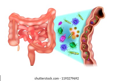 Disbiosis (también llamada disbacteriosis). Disbacteriosis del intestino - Bacterias del colon. 