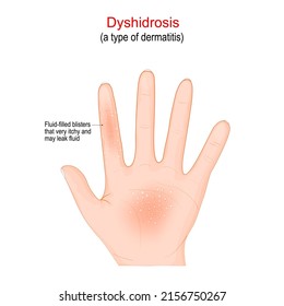 Disrosis. tipo de dermatitis con ampollas picantes en las palmas de las manos. Los blisters con líquido son muy picantes. Ilustración del vector