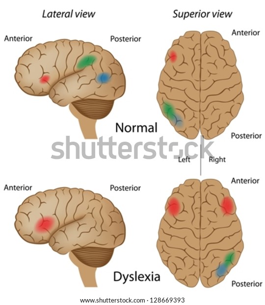 Dyslexia Brain Activity Stock Vector (Royalty Free) 128669393