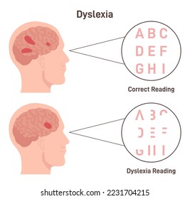 Dislexia. Trastorno de las letras dispersas al azar. Comparó la normalidad y el cerebro con la enfermedad. Trastorno del aprendizaje que implica dificultades de lectura. Ilustración vectorial plana