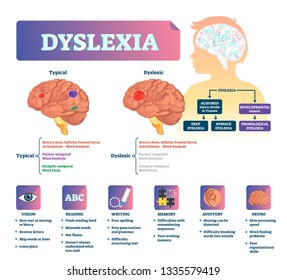 Ilustración vectorial dislexia. Plan de problemas de enfermedades cerebrales médicas etiquetadas. Comparó la normalidad y el cerebro con la enfermedad. Visión, lectura, escritura, audición de memoria y lista de síntomas neuro y diagnóstico.