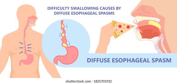 Dysphagia infection trachea examine Surgery choking gastric symptoms diagnose windpipe disorder bleeding surgical GERD treat tumor throat biopsy system ulcers stomach blocked eating food stuck test