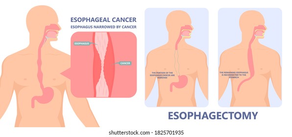 Dysphagia infection trachea examine Surgery choking gastric symptoms diagnose windpipe disorder bleeding surgical GERD treat tumor throat biopsy system ulcers stomach blocked eating food stuck test