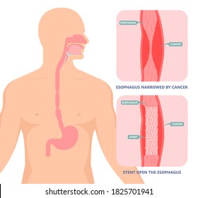 Dysphagia infection trachea examine Surgery choking gastric symptoms diagnose windpipe disorder bleeding surgical GERD treat tumor throat biopsy system ulcers stomach blocked eating food stuck test